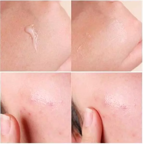 10 Pieces Dong-A Pharm Noscarna Acne Scars Removal Gels Face Facial Creams Large Size 20g Best help for getting rid of pimples D